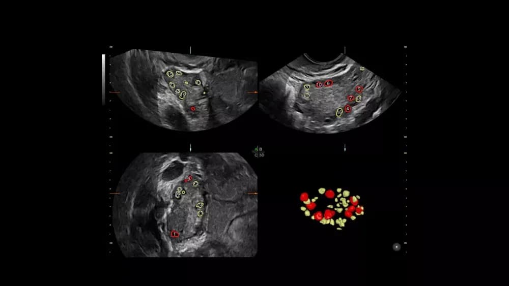 Sonoavc Antral — Ультразвуковая система