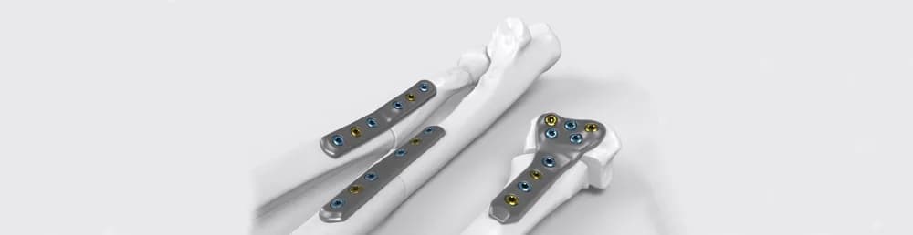 IPS Implants® Forearm Reconstruction — Individual implant yechimi (yuqori oyoq-qo'l)