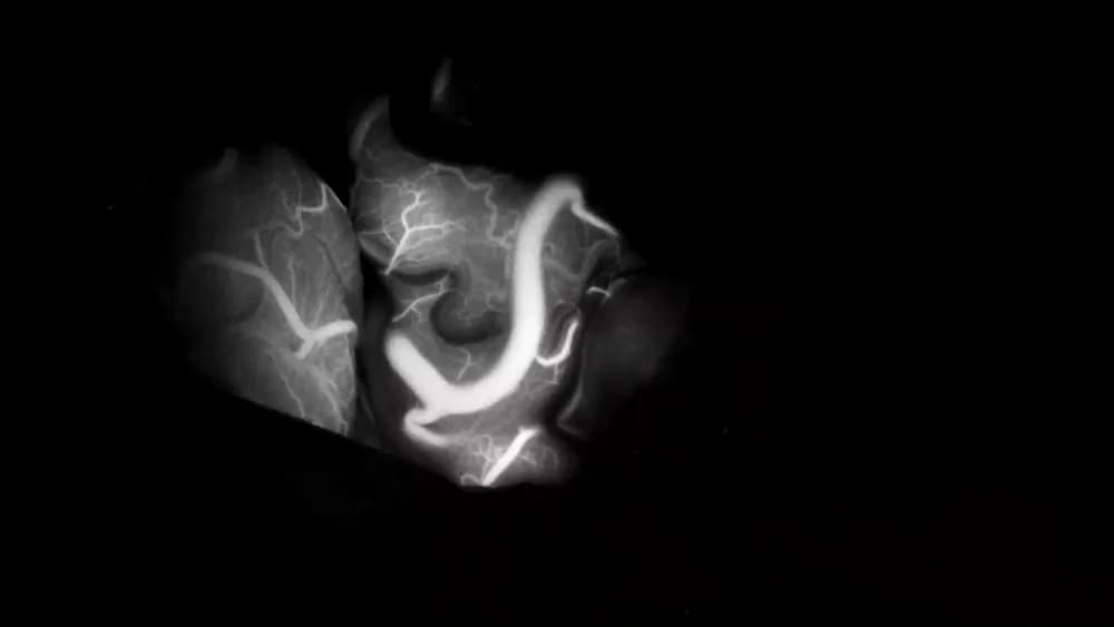 ZEISS Intraoperative Fluorescence Imaging — Интраоперационная флуоресцентная визуализация