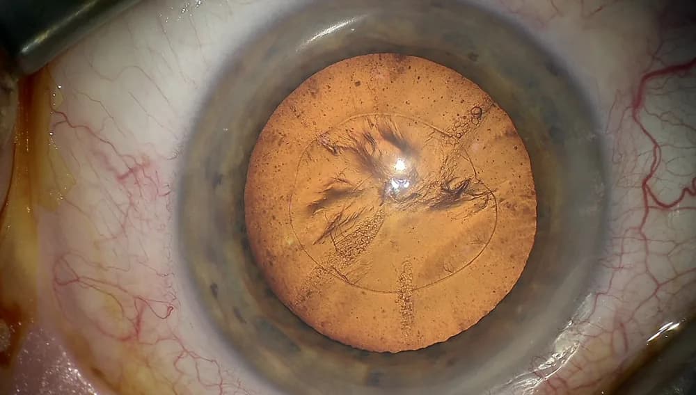 ZEISS OPMI LUMERA 300 — Jarrohlik mikroskopi