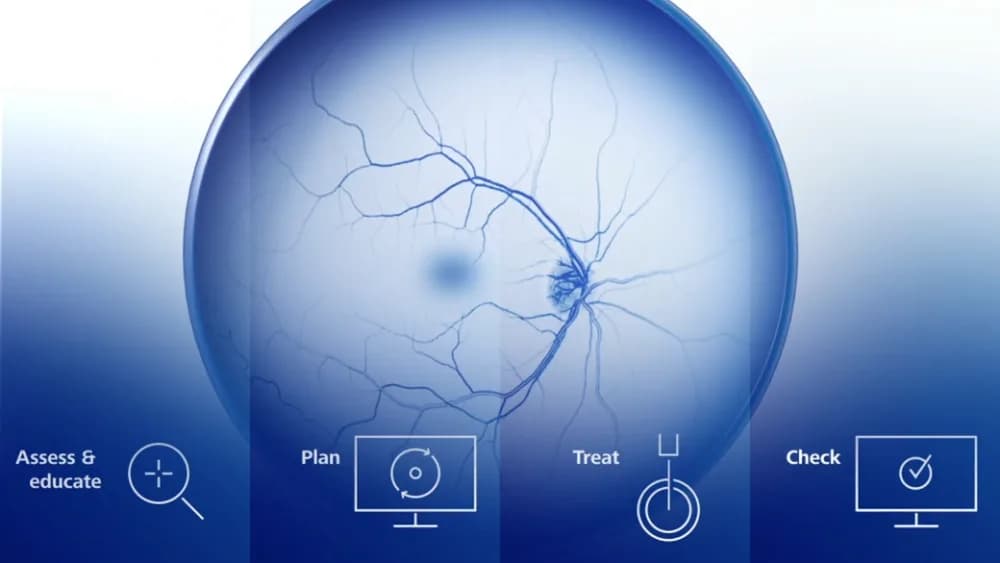 ZEISS VISULAS green — Terapevtik lazer
