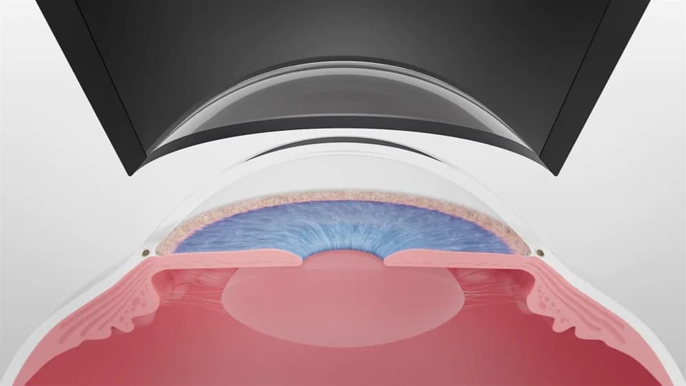 ZEISS VISULAS green SLT — Terapevtik lazer